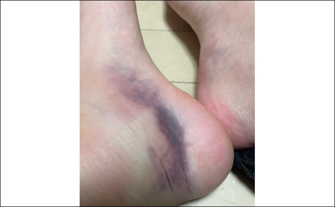 釣りの「めっちゃ痛い！」思い出　深夜に消波ブロックへ落下して奇跡の生還